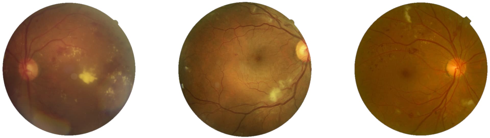 Retinopathy fundus images